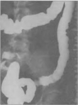 Обзорная рентгенограмма при язвенном колите
