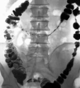 СРК. Рентгенограмма толстого кишечника при спастическом запоре